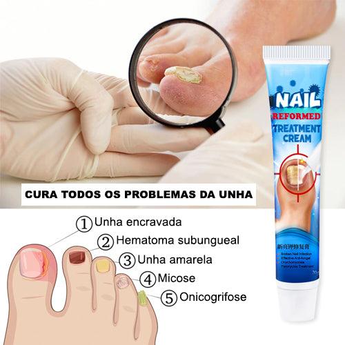 Nail Reformed - Tratamento de fungos e micose na unha