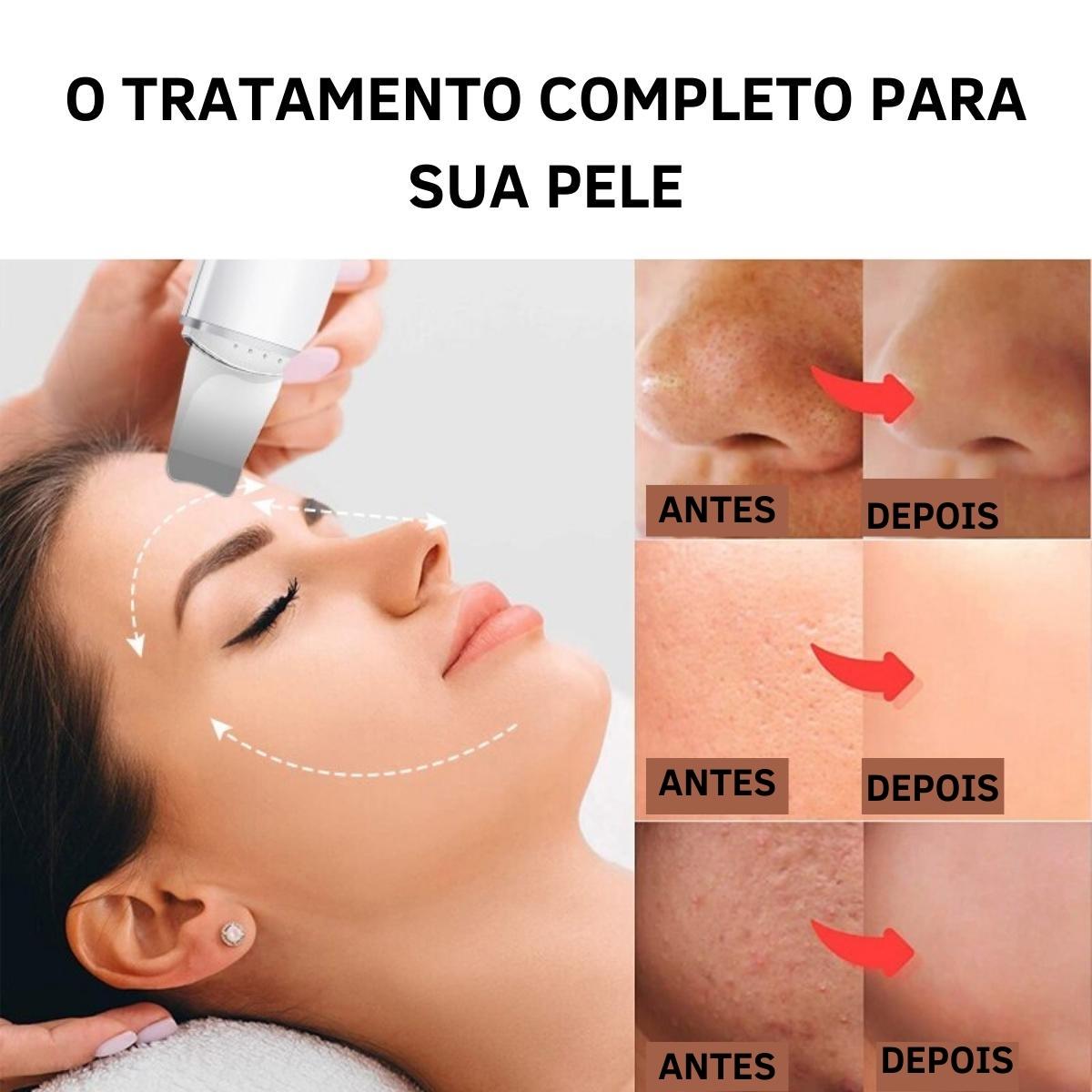 Aparelho Peeling Ultrassônico Limpeza Facial – Pele Radiante