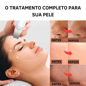 Aparelho Peeling Ultrassônico Limpeza Facial – Pele Radiante