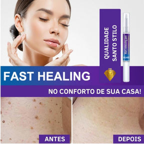 Creme Removedor de Verrugas – Fast Healing