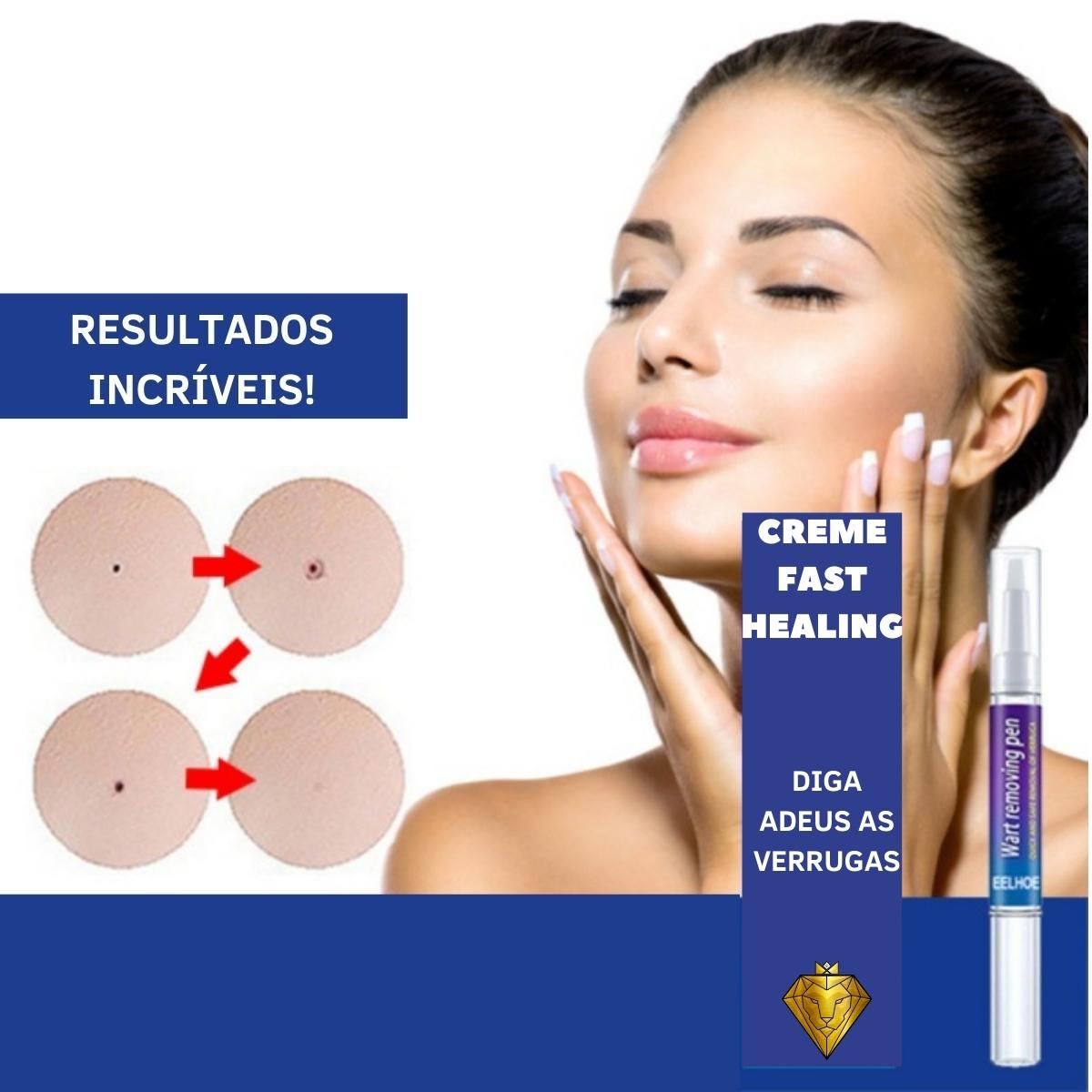 Creme Removedor de Verrugas – Fast Healing