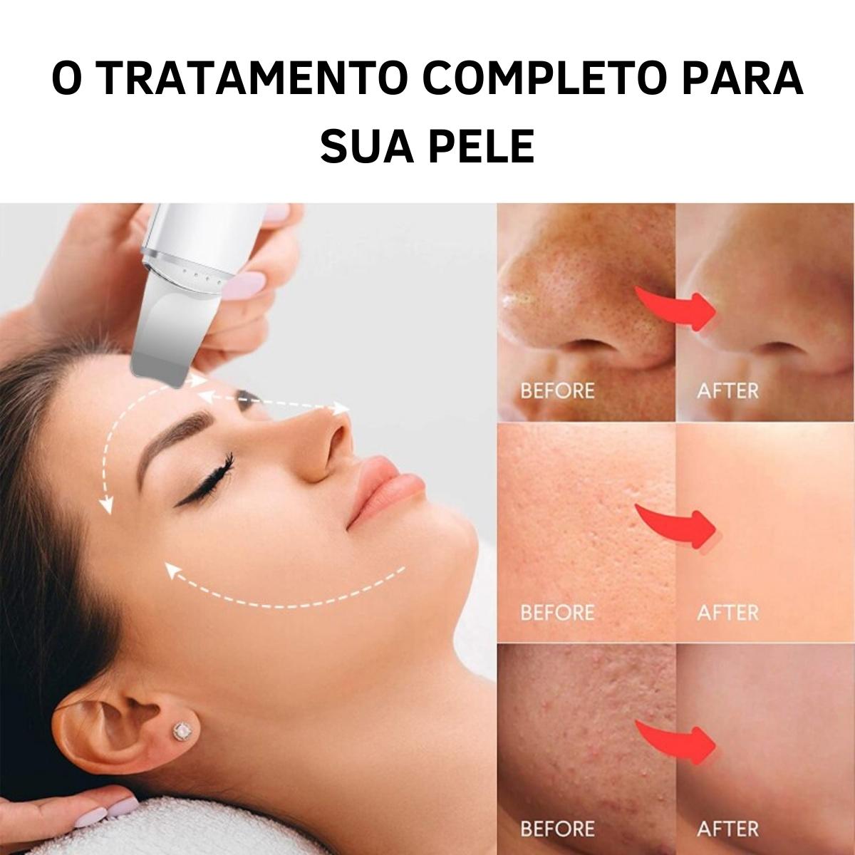 Aparelho Peeling Ultrassônico Limpeza Facial – Pele Radiante