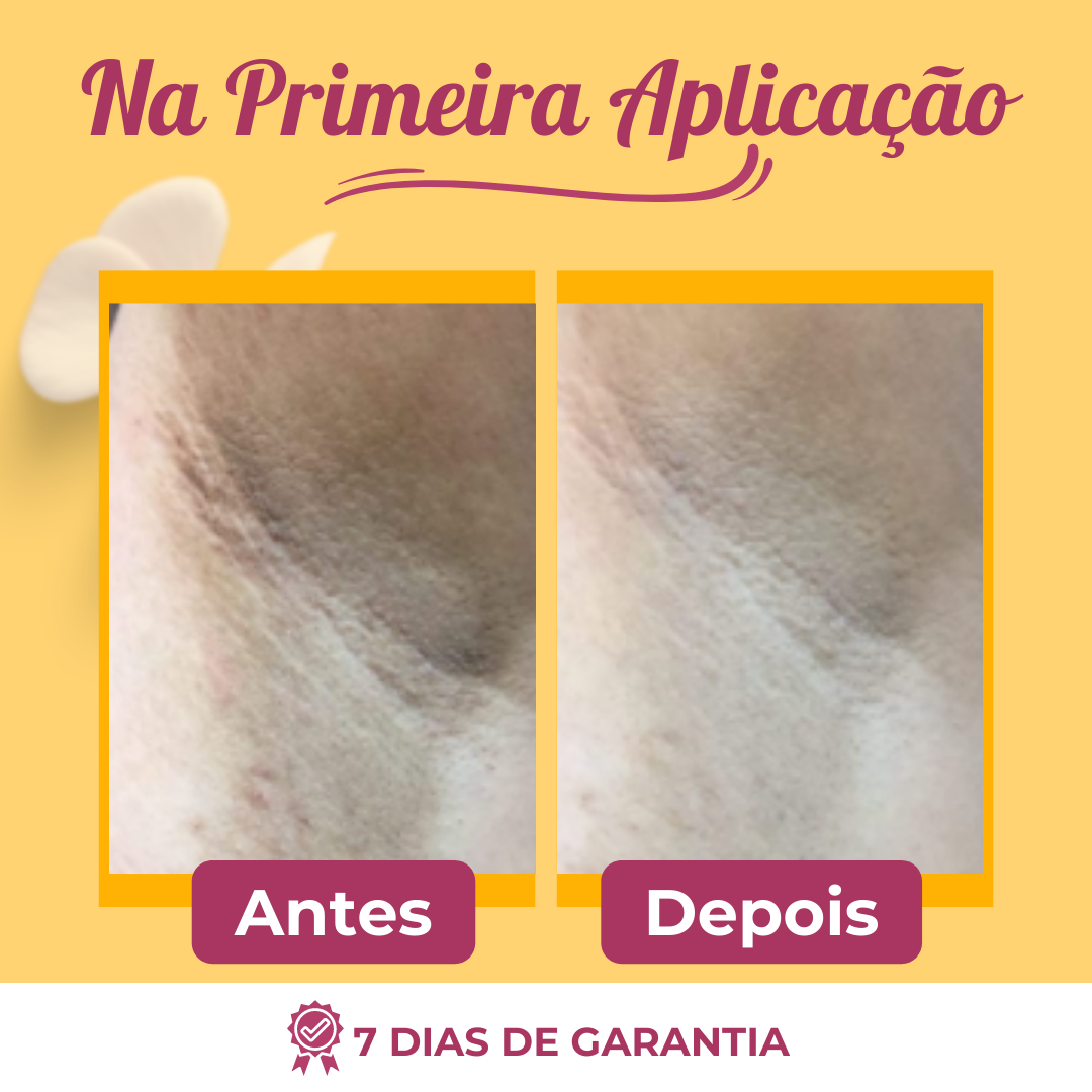 Retinou™ Creme Para Clareamento, Retire a Manchas Excessivas de Qualquer Região