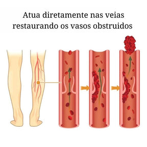 Adesivo removedor de Varizes – Varicose Veins