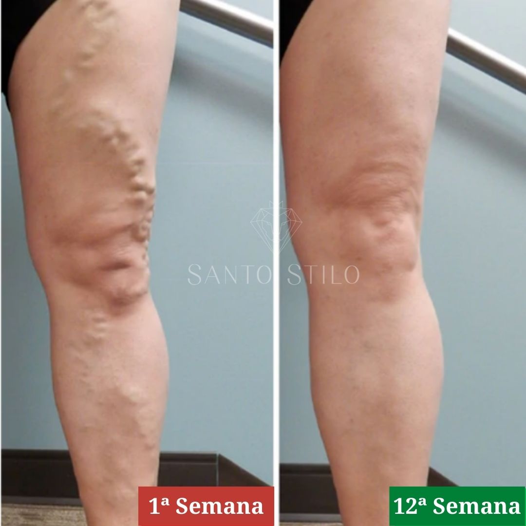 Adesivo removedor de Varizes – Varicose Veins