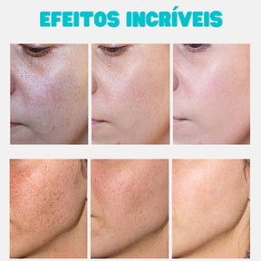 Creme para Melasma - Melaslow