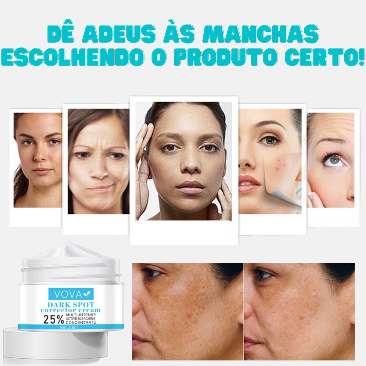 Creme para Melasma - Melaslow