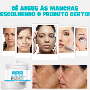 Creme para Melasma - Melaslow