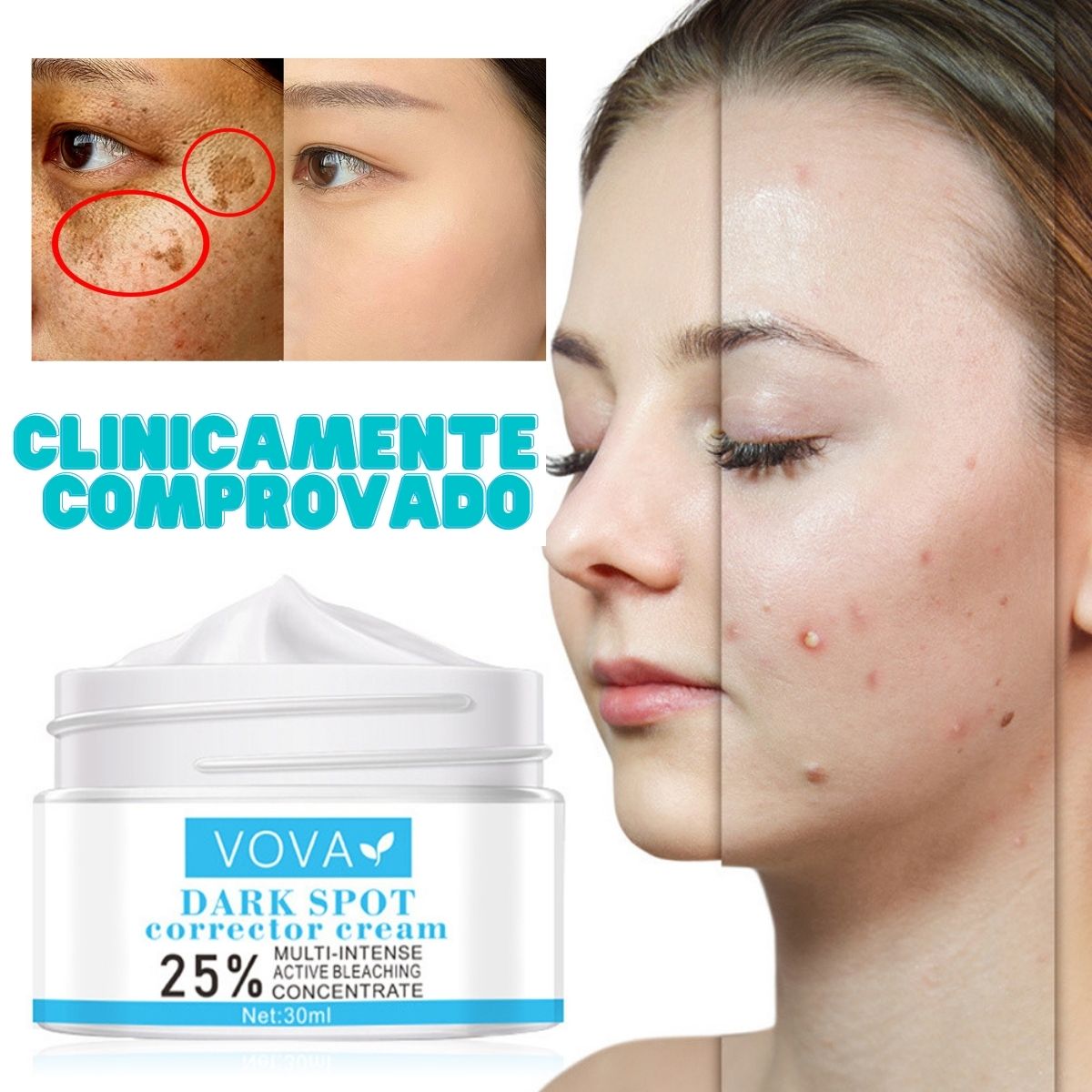 Creme para Melasma - Melaslow