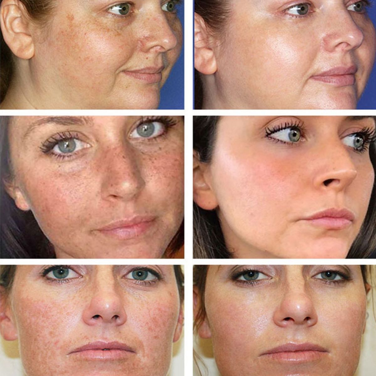 Creme para Melasma - Melaslow