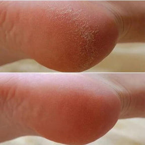 Pedicure Pro® Lixa de Pé Elétrica para Calos e Rachaduras nos Calcanhares, Removedor de Peles Mortas Profissional Em Casa