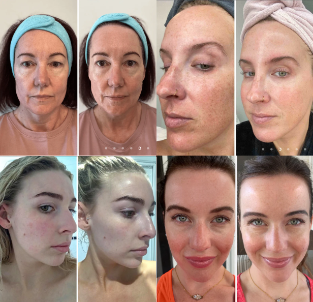 BiocollagenPlus - Máscara absorvível de colágeno + ativos do botox.